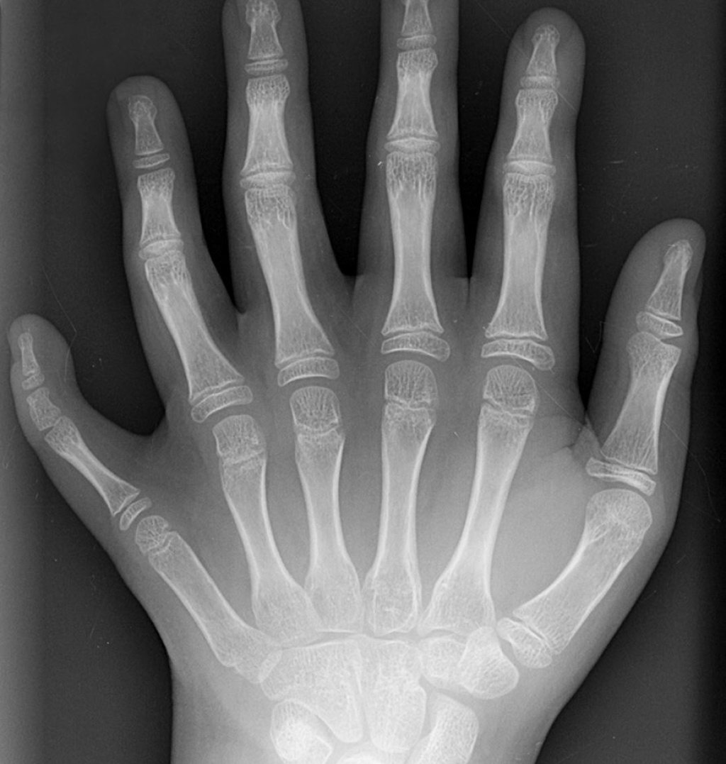 Polydactyly_01_Lhand_AP