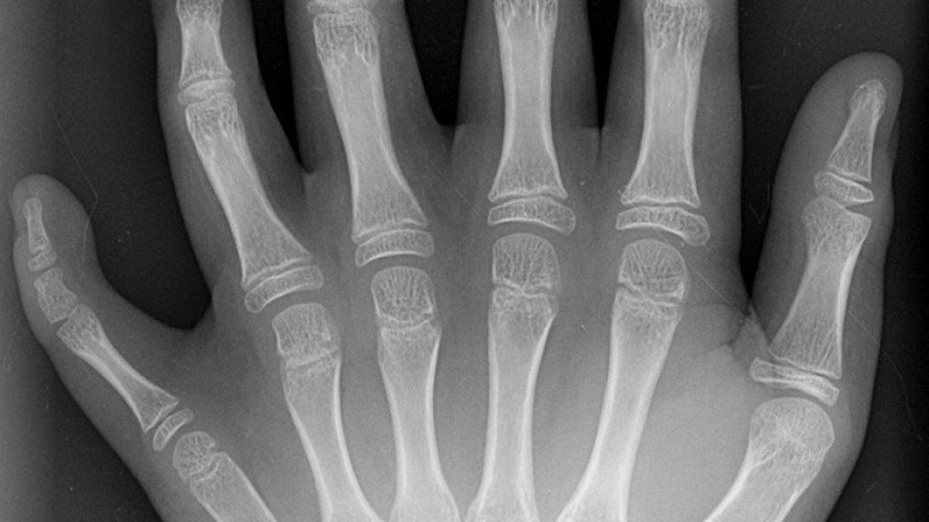 Polydactyly_01_Lhand_AP