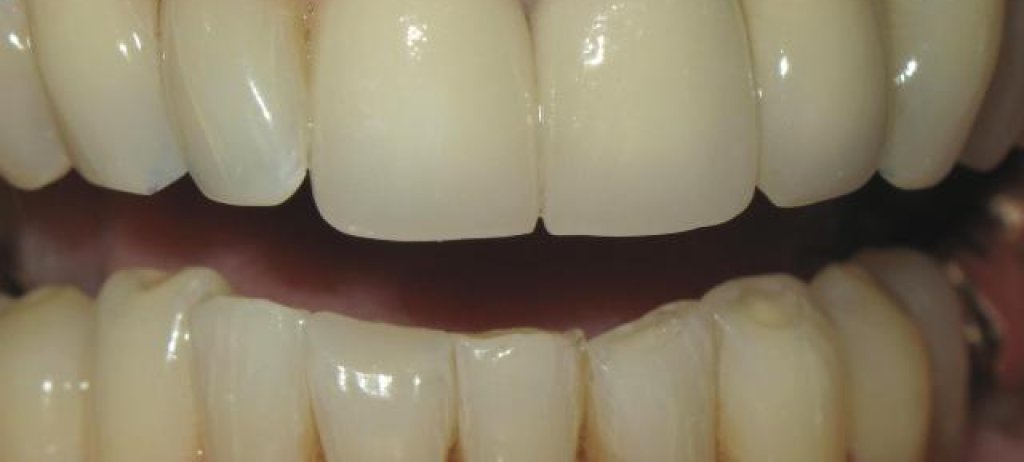 24_Right Occlusal