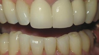 24_Right Occlusal