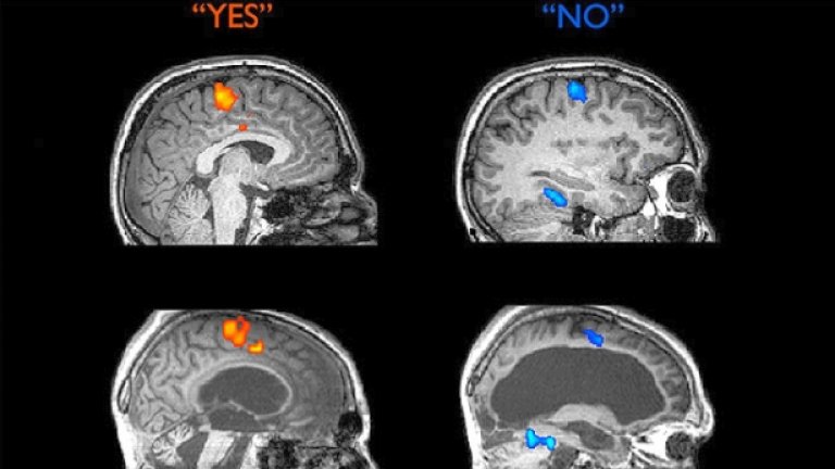 Цветните петна в мозъка, отговарящи на "да" (червено) и "не" (синьо) в мозъка на здрав човек (горе) и на човек във кома (долу)