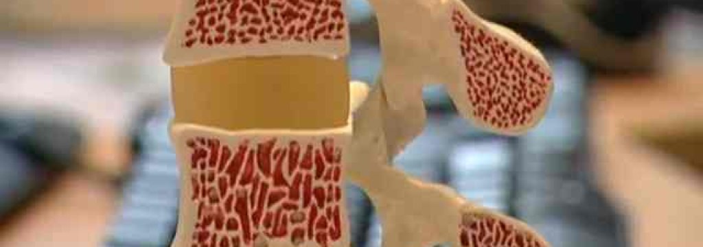 osteoporose