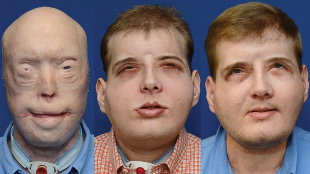 160824174557-facetransplant1-full-169