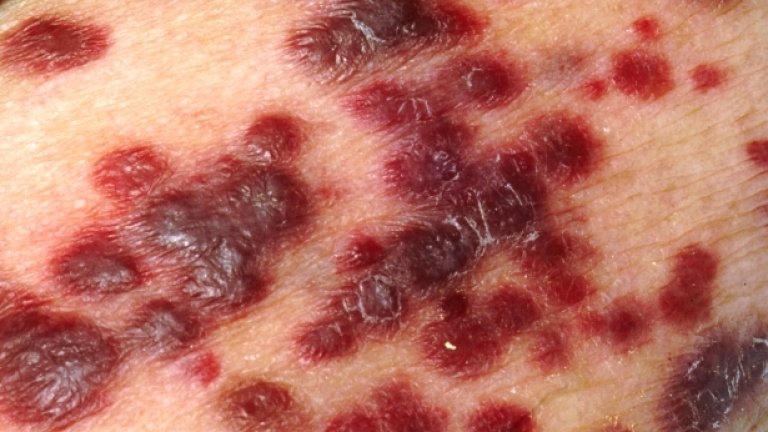 Саркомът на Капоши е злокачествено заболяване на кожата, характерно за развития СПИН