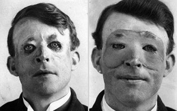Уолтър Йео, един от първите хора, които се подлагат на пластична операция и трансплантация на кожа, 1917 г.

