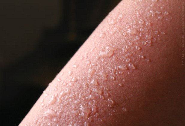Изгаряния от втора степен могат да доведат до мехури по кожата и обикновено са много болезнени. Не бива да се опитвате да пукате образуващите се мехури, защото те предпазват увредената кожа