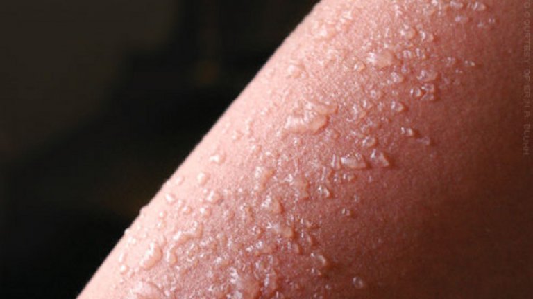 Изгаряния от втора степен могат да доведат до мехури по кожата и обикновено са много болезнени. Не бива да се опитвате да пукате образуващите се мехури, защото те предпазват увредената кожа