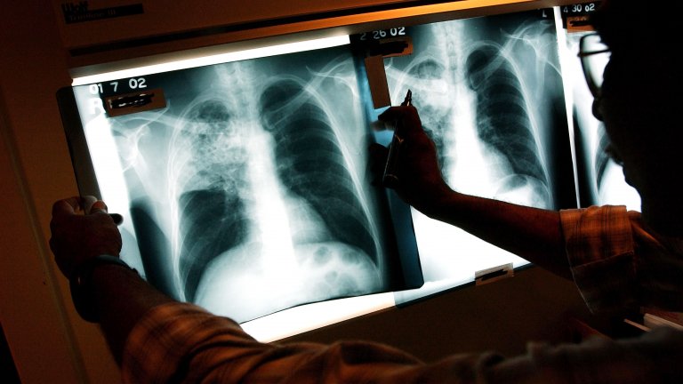 Туберкулозата поразява белите дробове.