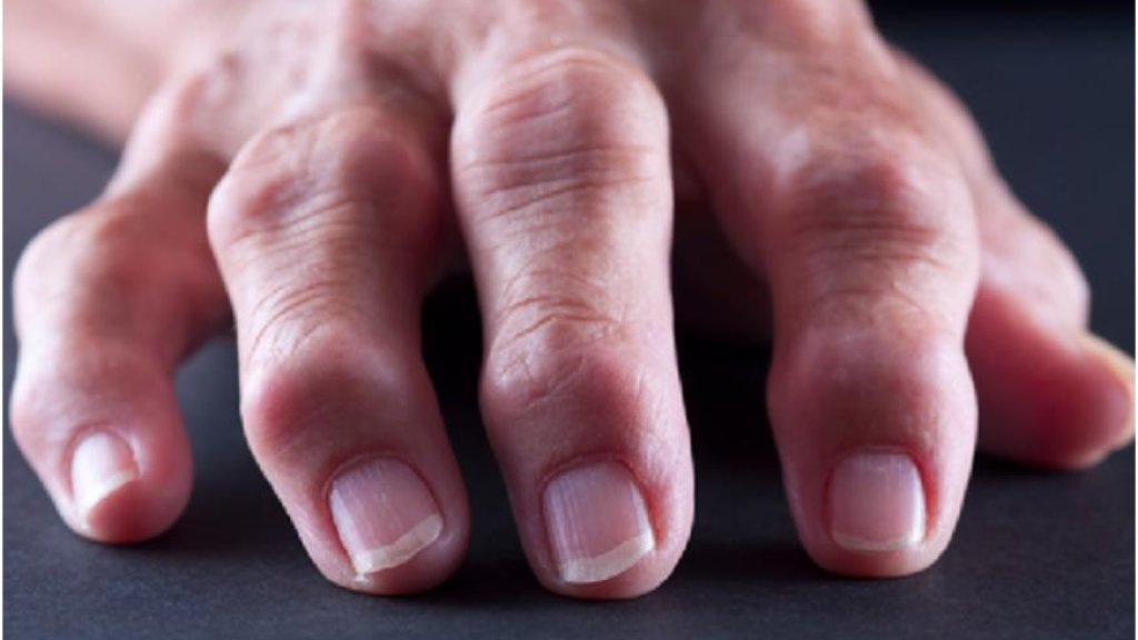 Arthritis
