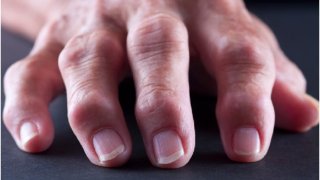 Arthritis