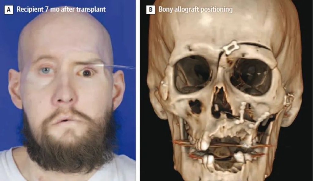 transplantacia