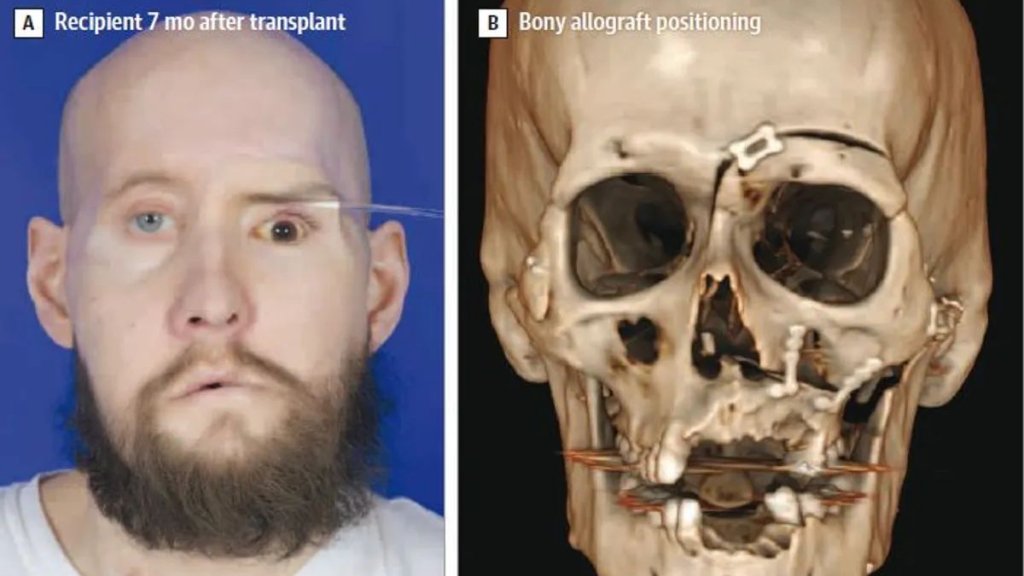 transplantacia