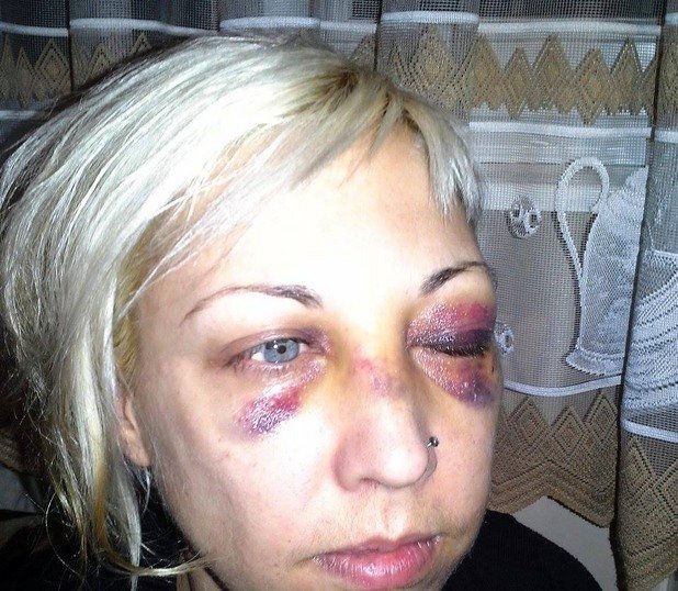 Божилова пише, че приятелят й е със счупена ръка, а тя - с окървавено лице, счупен нос и множество отоци.
