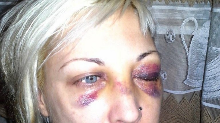 Божилова пише, че приятелят й е със счупена ръка, а тя - с окървавено лице, счупен нос и множество отоци.