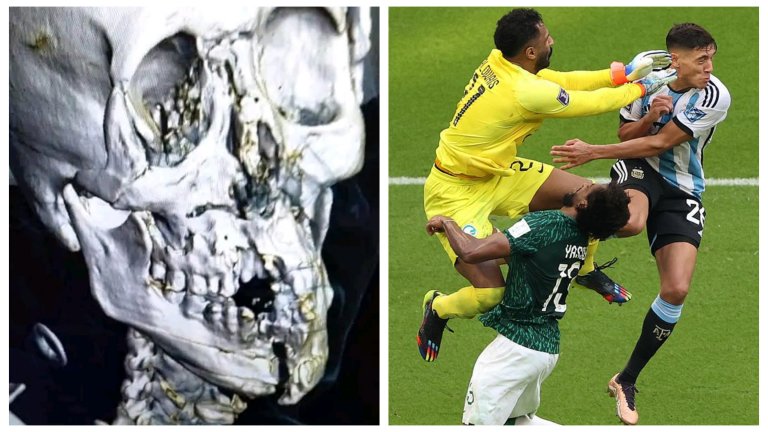Счупена челюст, натрошени кости, вътрешен кръвоизлив - най-бруталната контузия на Мондиал 2022