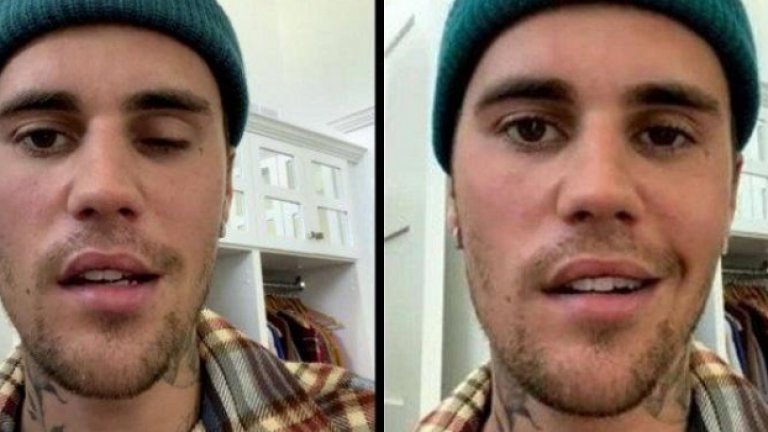 Синдромът на Рамзи Хънт се причинява от реактивиране на вируса на варицелата