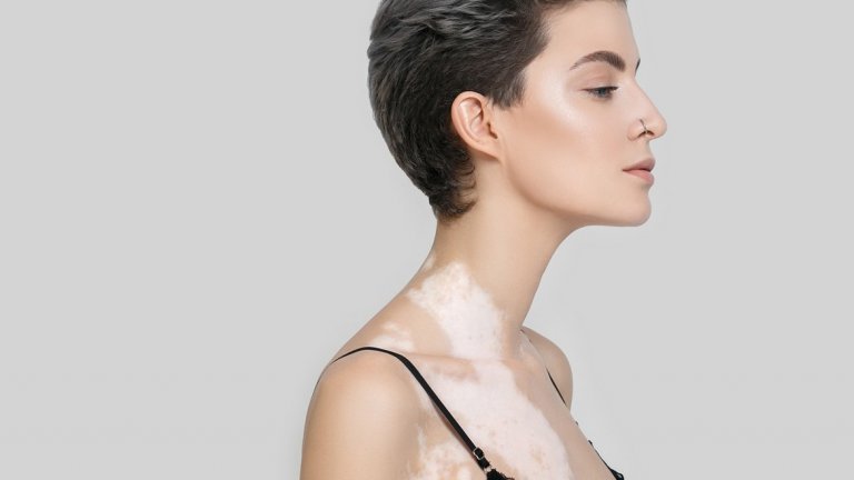 Удар по самочувствието...
Макар основното отражение на витилиго да е по-скоро козметично и да засяга външния вид на човек, по-голямо отражение то може да има върху емоционалното здраве. Появата на петната по видими места от тялото като лицето и ръцете, може да доведе до стрес и да повлияе на увереността на хората с това състояние на кожата в интимен план, а още по-силно може да се отрази на младежите, които са по-обсебени от това как изглеждат.