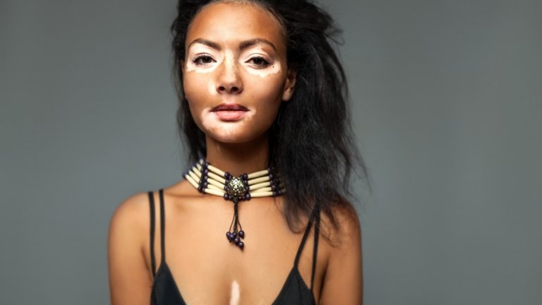 Що е то "витилиго"?
Името на заболяването "витилиго" идва от латинските думи vitium (петно, белег)  и ligo (причина). То напълно отговаря на основното си проявление – кожата на места губи пигментация и там се появяват светли петна. Естествено, при хората с по-тъмна кожа това е много по-забележимо. 
Според различни източници около 1-2 процента от човечеството имат някаква форма на витилиго. При по-голямата част от хората, то се е появило преди да навършат 40 години. Състоянието не е ново – напротив, има исторически доказателства, че е съществувало през цялата ни история.