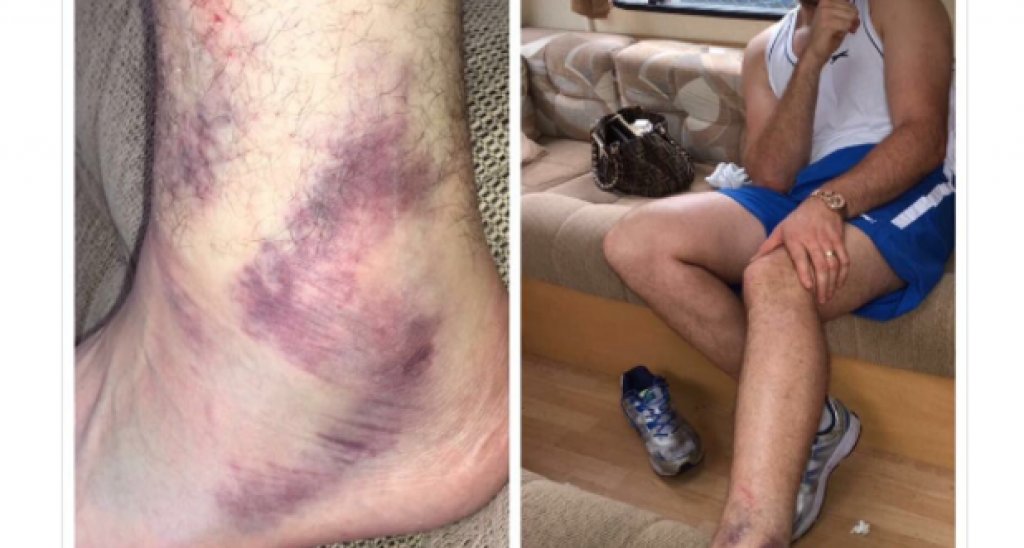 През юни Фюри показа в Instagram, че е контузил крака си по време на подготовката за реванша и мачът бе отменен