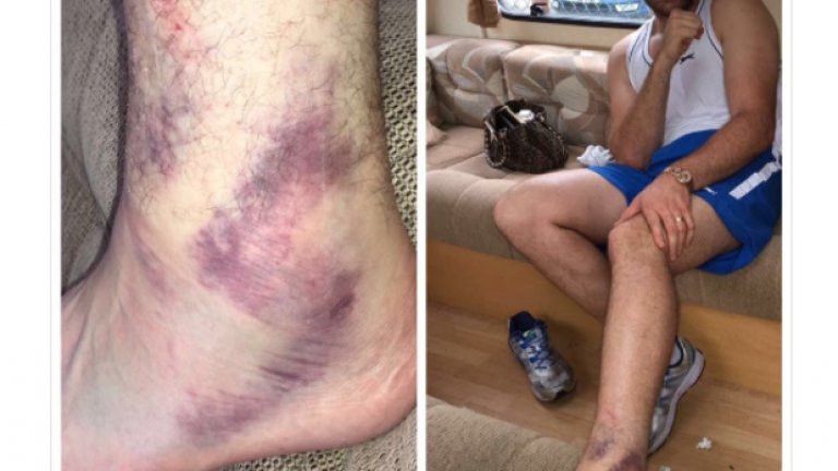 През юни Фюри показа в Instagram, че е контузил крака си по време на подготовката за реванша и мачът бе отменен