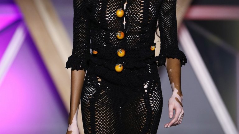 ...или повод за гордост
Човек може да се пребори с негативните последствия от появата на витилиго както с помощта на терапевт, така и на близките и роднините си. Да се говори открито за състоянието, какво го причинява, какво представлява и пр. също е полезен подход и помага както на човека с витилиго, така и на околните.
По света вече има примери за хора, които не само се преодолели притесненията от петната по кожата, но и са ги превърнали в своя специфична черта – такава, на която наблягат и която дори може да повлияе на кариерата им.
Пример е канадският модел Уини Харлоу, която също има витилиго. Като дете тя е била обект на подигравки, но от години работи за публичното разясняване на това какво представлява заболяването. Днес е модел с успешна кариера и вдъхновител за хората с това състояние.