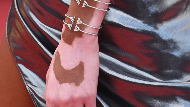 Витилиго не е заразно
Ако се чудите дали е възможно да се заразите, отговорът е "не" – заболяването не е заразно.