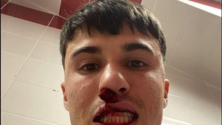 Безумец нахлу на терена и счупи носа на футболист на Фиорентина (видео)