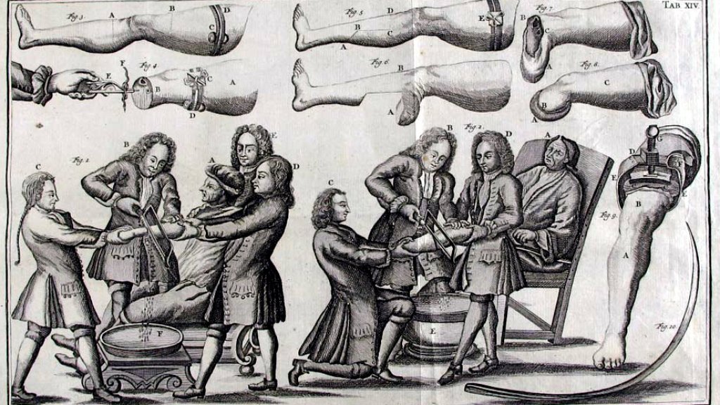 Amputations_18c