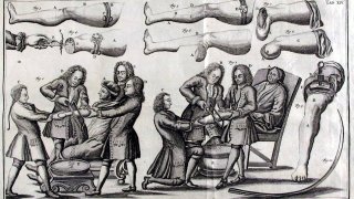 Amputations_18c