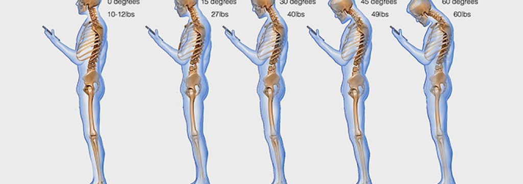 spine-phone-looking-down-neck-texting1