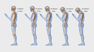 spine-phone-looking-down-neck-texting1