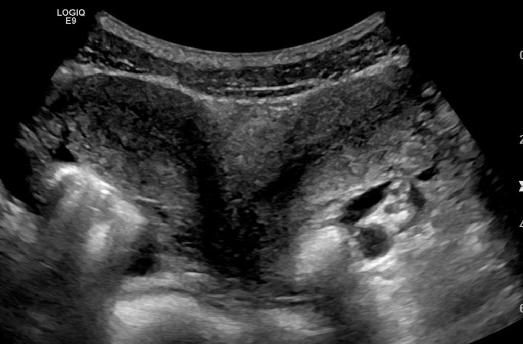 Uterus_didelphys_0001