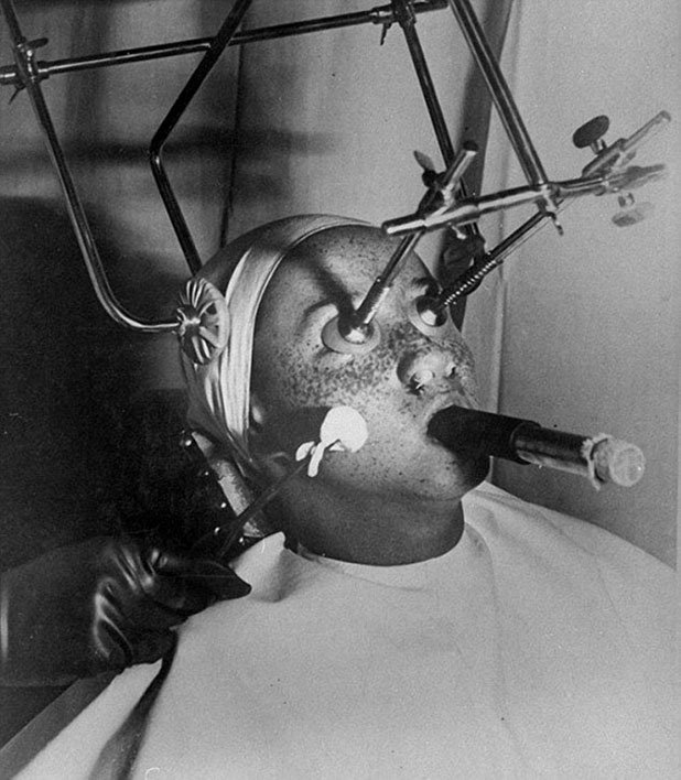 През 30-те години е било популярно т.нар. "замразяване" на лунички с въглероден диоксид. Пациентът диша през тръба, като върху очите се поставят херметически затворени тапи, а ноздрите се запушват.