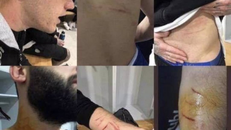 Футболисти на Сакаря показаха раните си след мача с Амедспор.