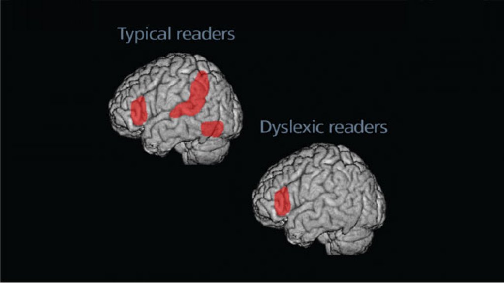 Dyslexia Today