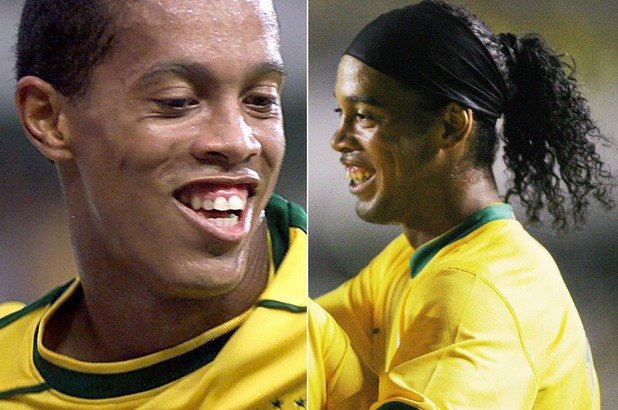Зъбите на Роналдиньо добиха легендарен статут и му спечелиха прякора Заека. През 2013 г. бразилецът се бръкна с 50 000 евро за нова усмивка.