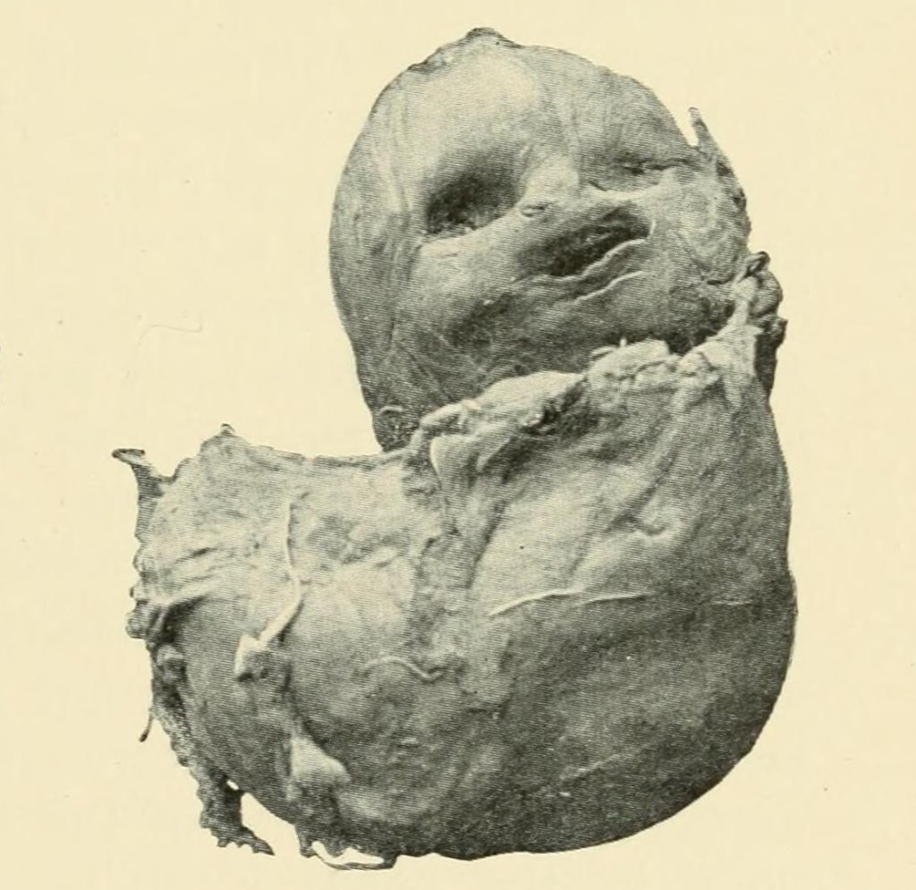 Lithopedion_1898