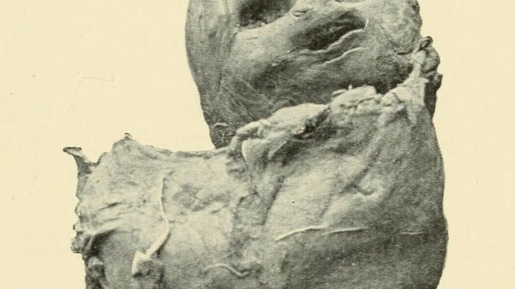 Lithopedion_1898