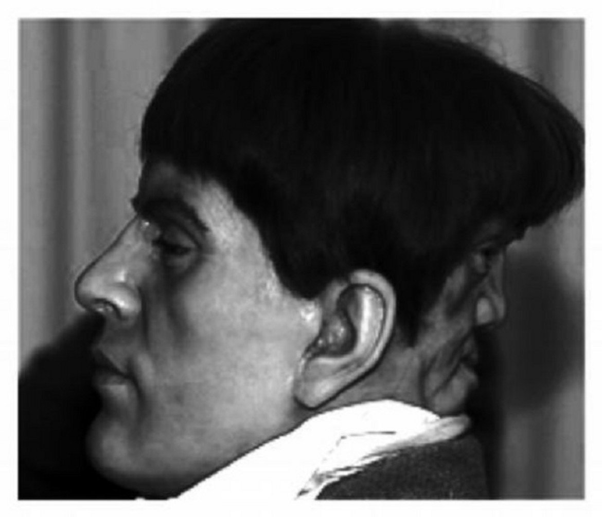 Паразитният близнакПрез XIX век в Англия живеел млад мъж на име Едуард Мордрейк - приятен на вид и талантлив. Той обаче имал един проблем, на тила си имал второ лице.Подобна аномалия макар и рядко срещана, е позната на медицината. Явлението е известно под името craniophagus parasiticus ("паразитен близнак"), при което още в майчината утроба по-силният близнак убива по-слабия, асимилирайки го с тялото си. Когато обаче това поглъщане не е пълно, част от близнака остава извън тялото на другия близнак и е видима.