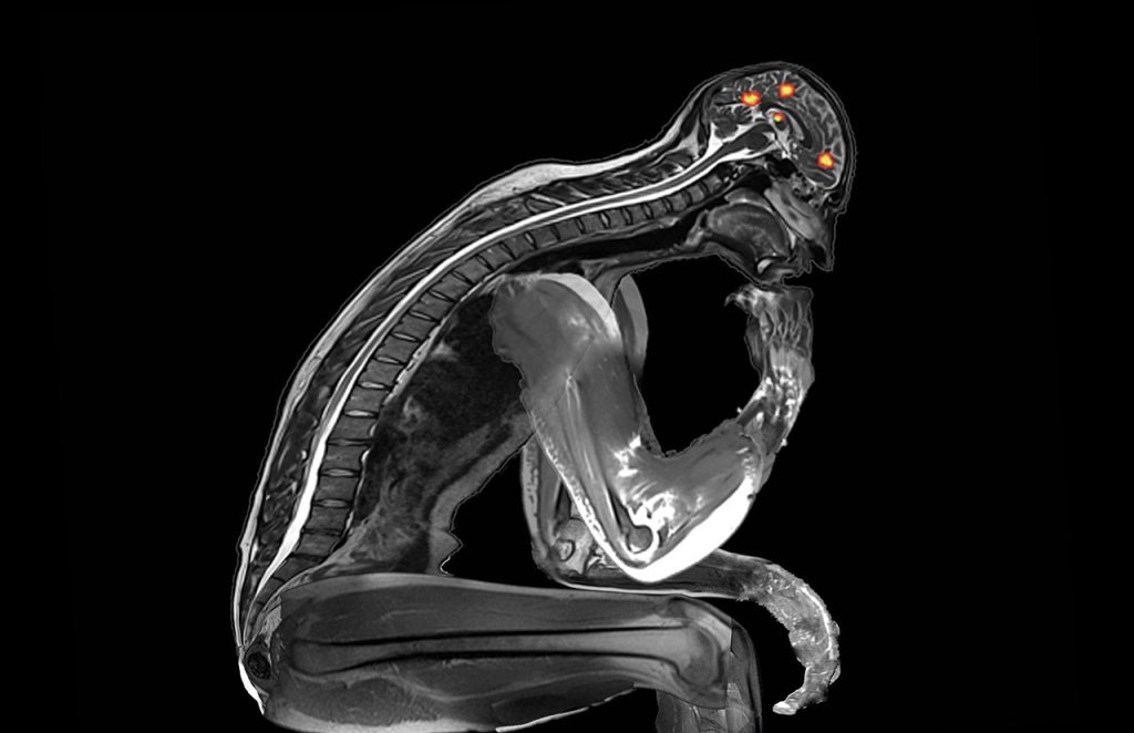 Thinker_mri