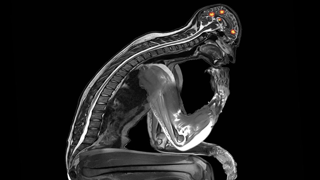 Thinker_mri
